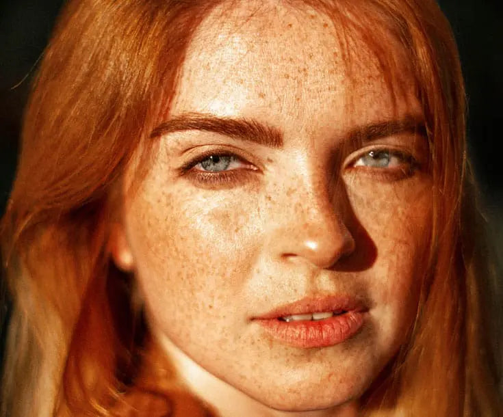Freckles, Sun Spots or Melasma? Why the Right Pigmentation Diagnosis Matters