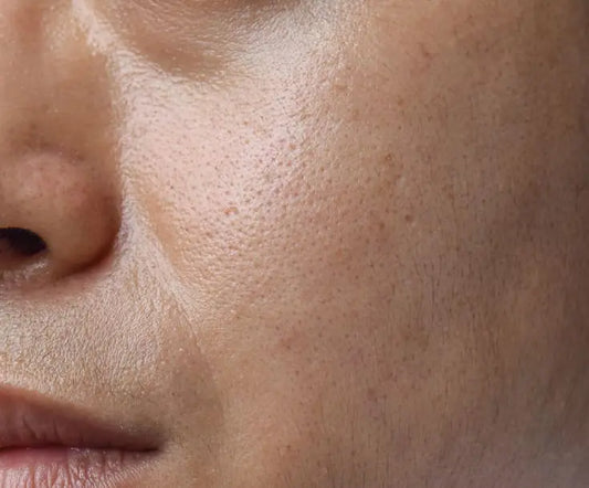 Laser Season Is Back: Why Autumn Is the Perfect Time to Treat Summer Skin