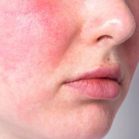 Redness, Rosacea and Broken Capillaries: Which Laser or Light Treatment Works Where?