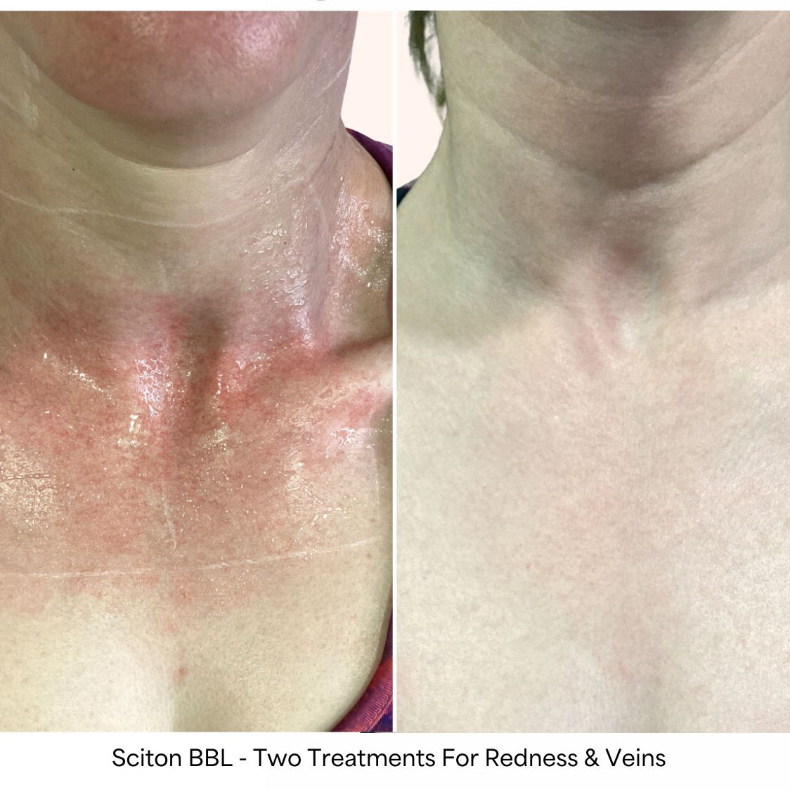 Sciton BBL Laser for pigmentation
