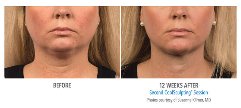 Coolsculpting Double Chin 2 1 Laser And Skin Clinics