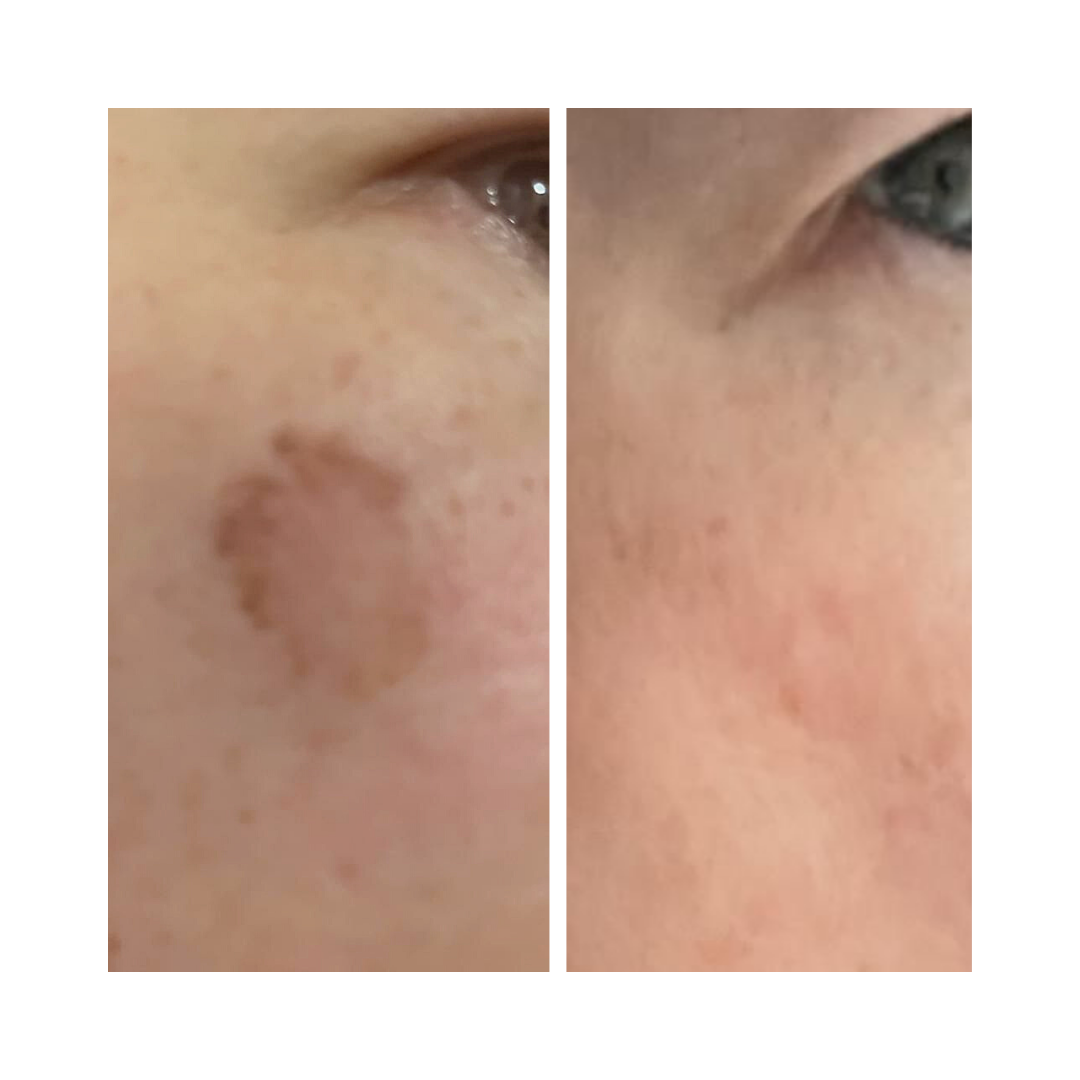 Laser Pigmentation Removal Laser and Skin Clinics