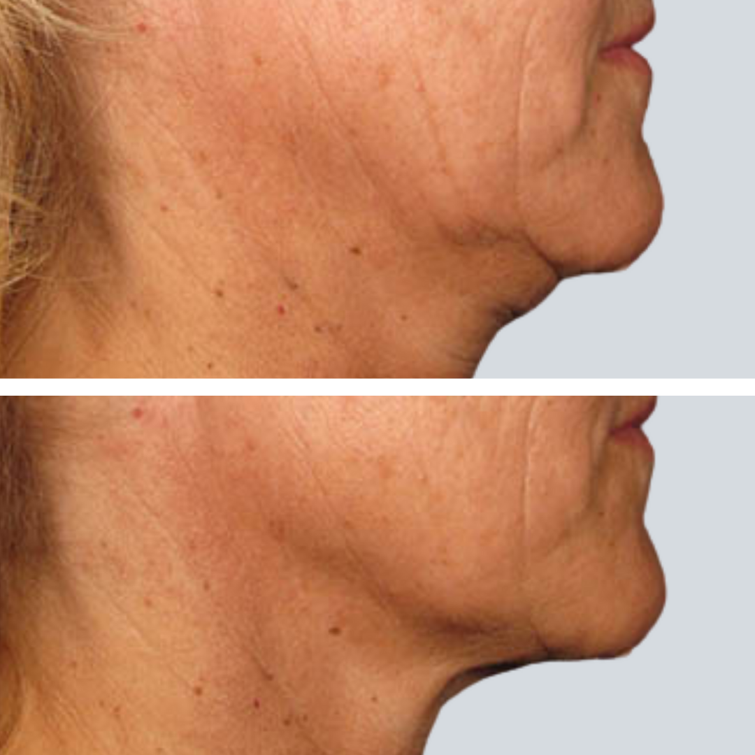Ultherapy