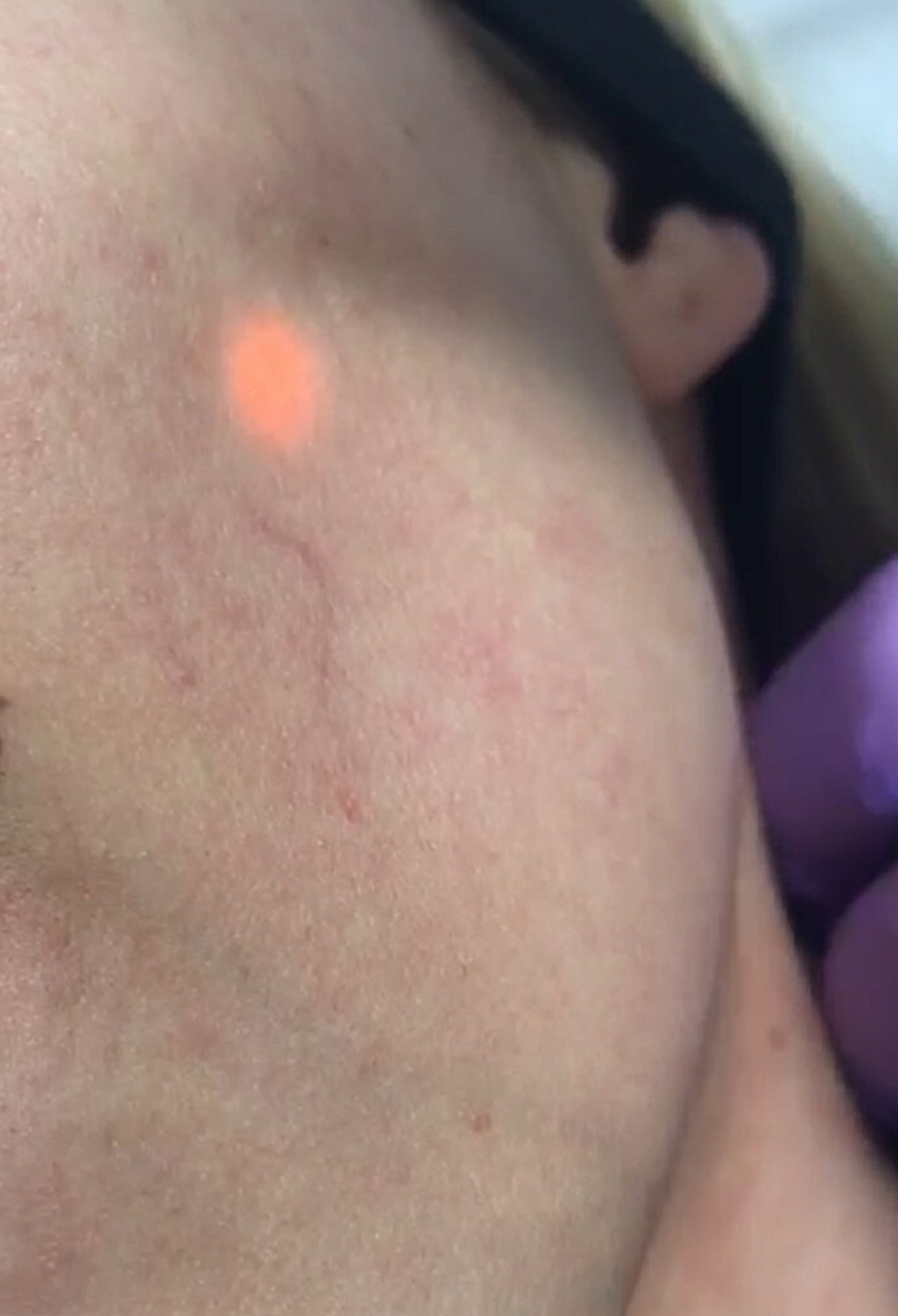 LaserVein_General_Picture