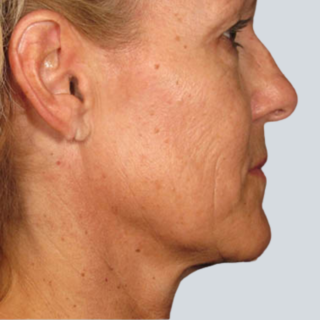 Ultherapy The Laser and Skin Clinic