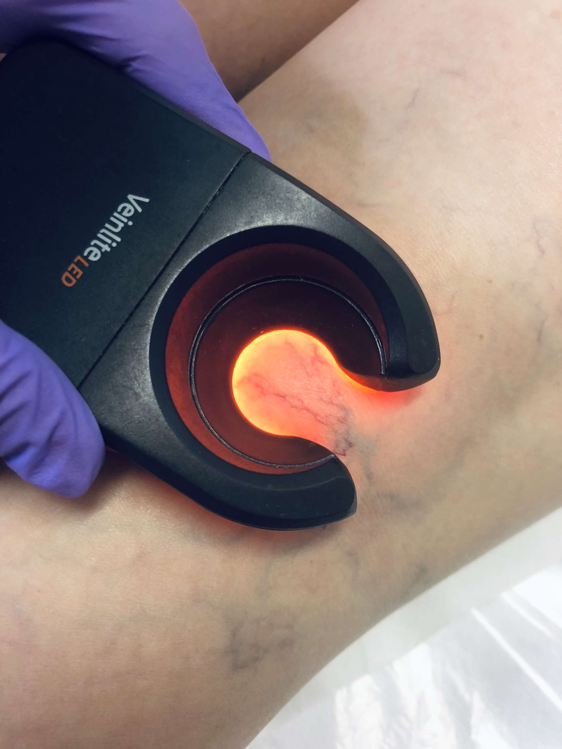 Sclerotherapy_General_Picture