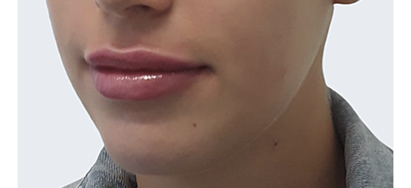 Lip Area – The Laser and Skin Clinic