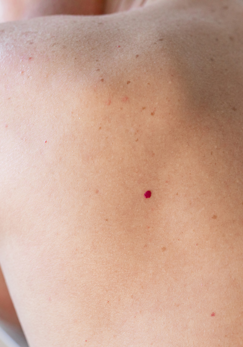 Cherry Angiomas The Laser And Skin Clinic 