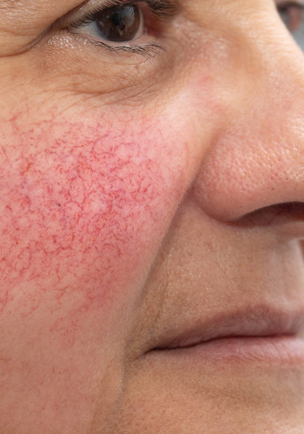 facial-veins-redness-laser-and-skin-clinics