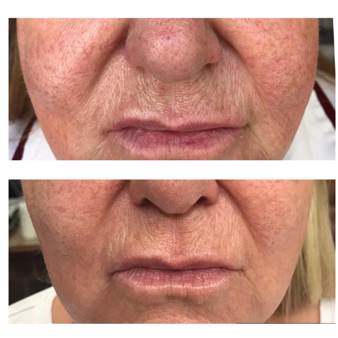 Lip-Area-treatments-General