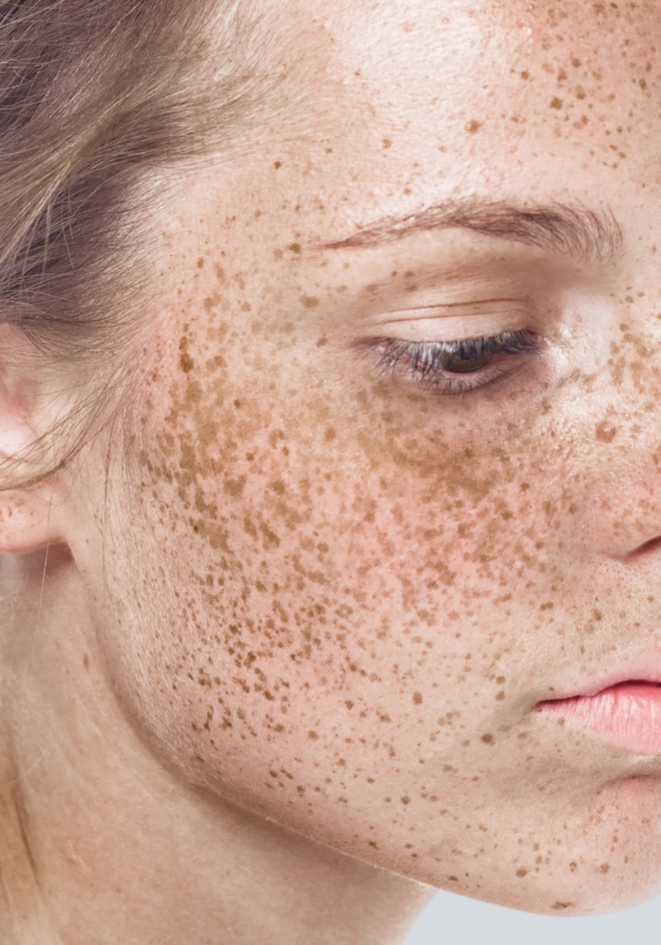 Pigmentation – Laser And Skin Clinics