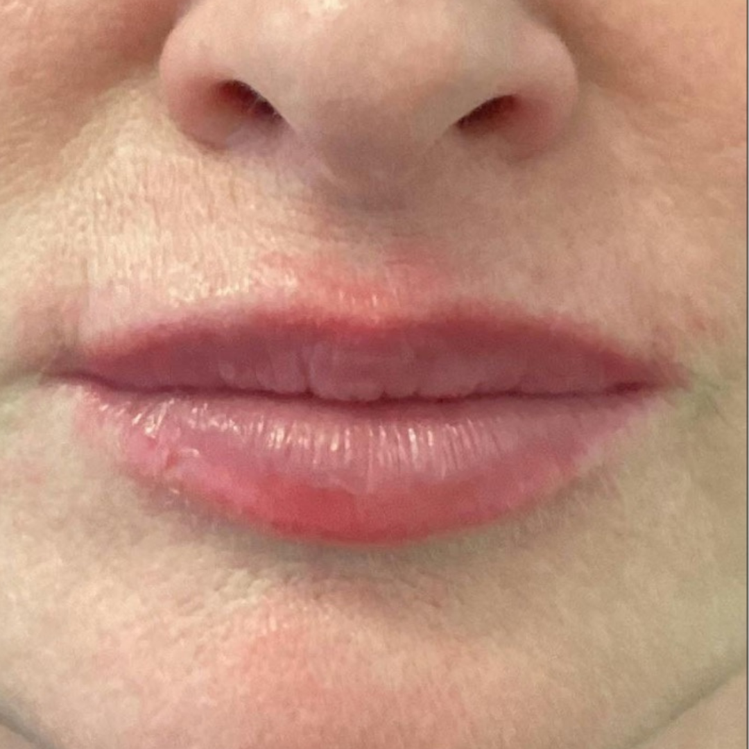 Lip filler after