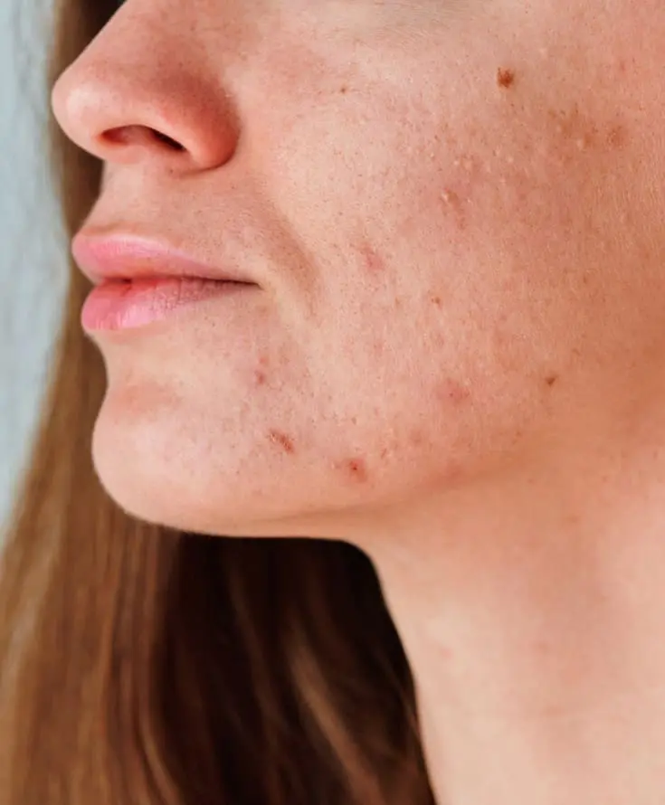 Laser & Skin Clinics - Acne