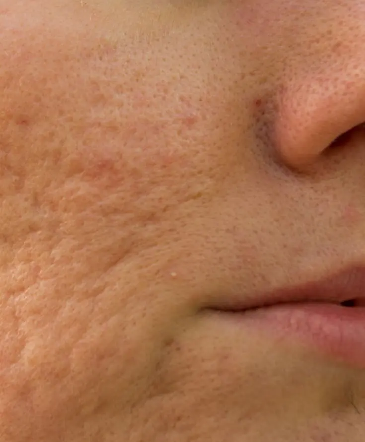 Laser & Skin Clinics - Acne Scarring