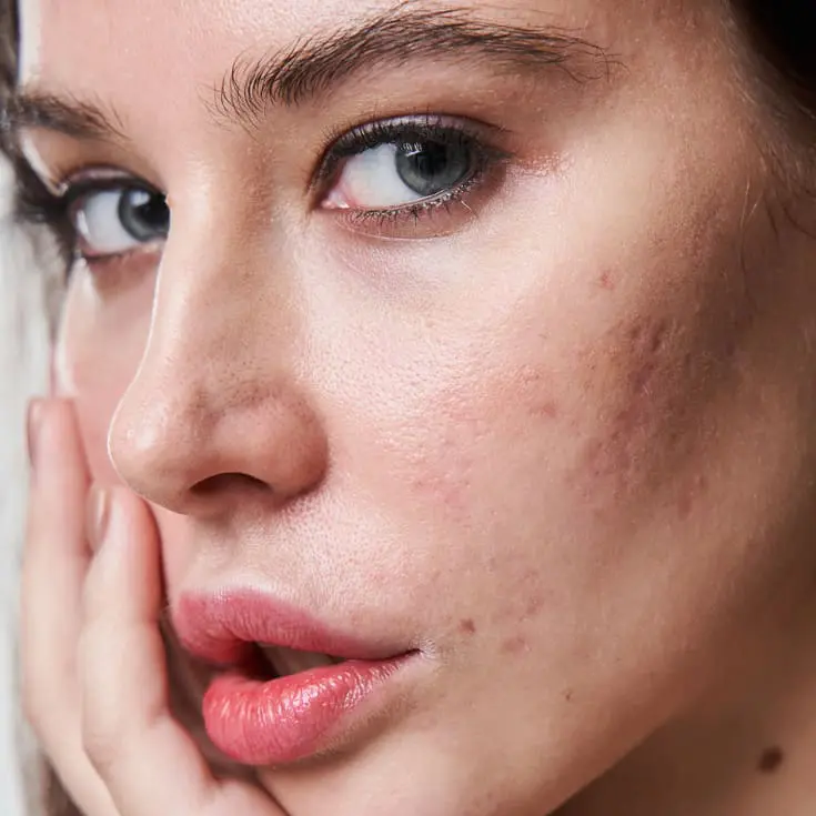 Laser & Skin Clinics - Acne Scarring