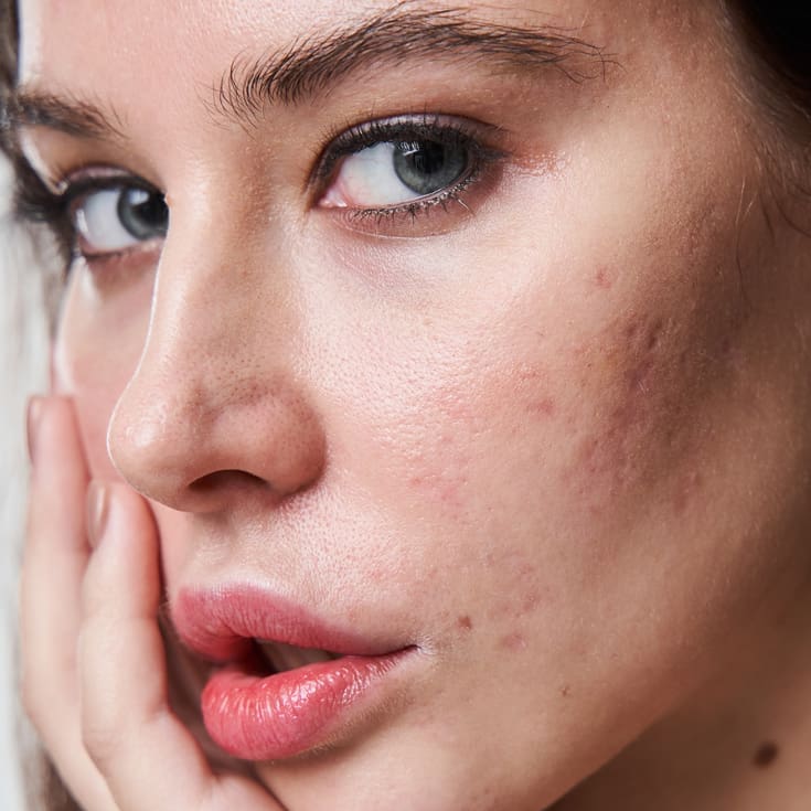 Acne Scarring Treatment Dublin | Laser + Skin Clinics