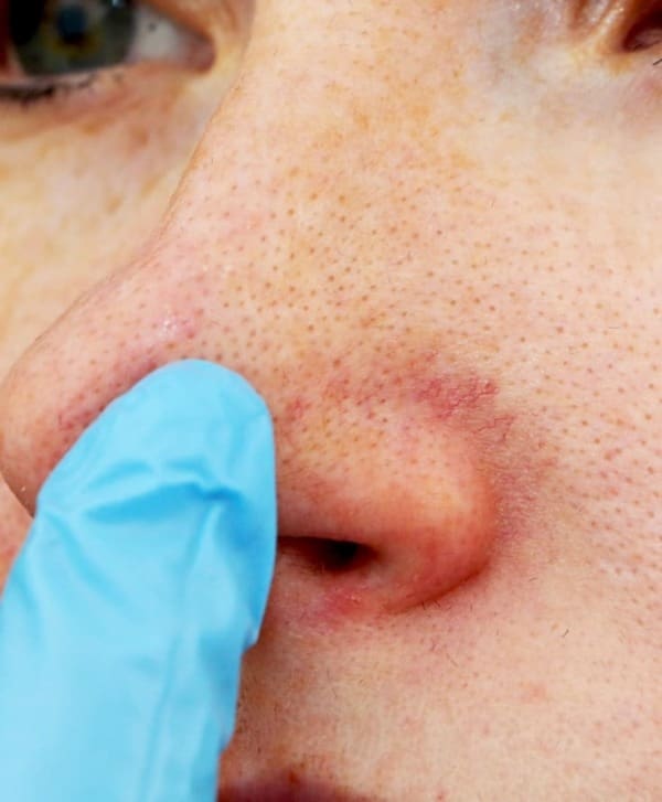 Best Broken Capillaries Treatment Dublin Laser + Skin Clinics