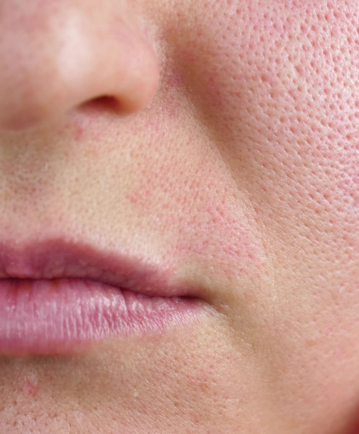 Laser & Skin Clinics - Enlarged Pores