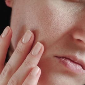 Laser & Skin Clinics - Enlarged Pores