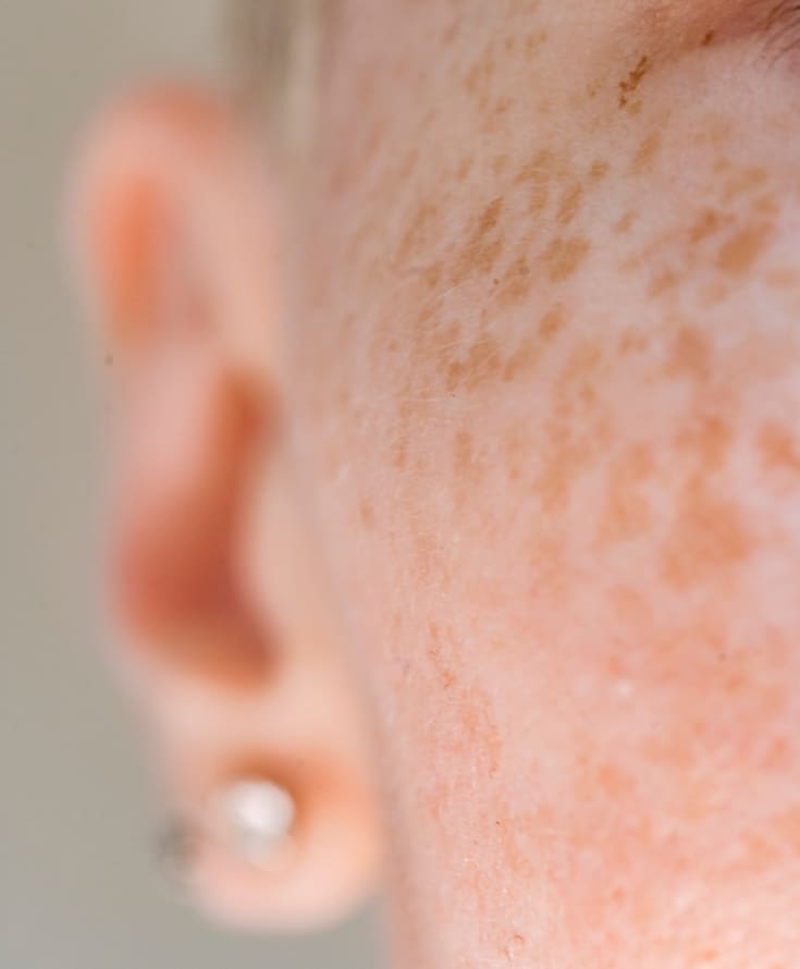 Laser & Skin Clinics - Freckles