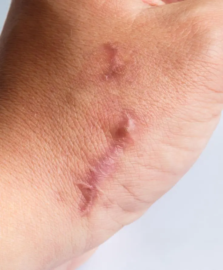 Laser & Skin Clinics - Hyperttrophic Scars