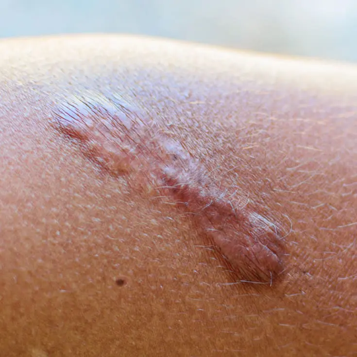 Laser & Skin Clinics - Hyperttrophic Scars