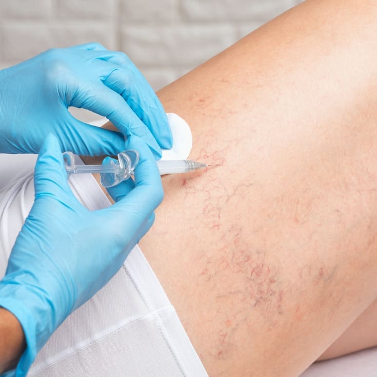 Laser & Skin Clinics - Leg Veins