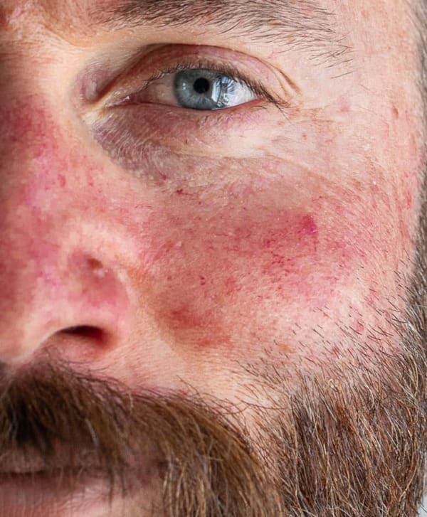 Best Rosacea Treatments Dublin Laser + Skin Clinics