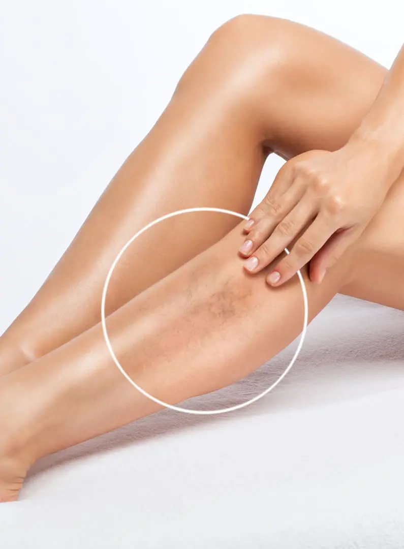 Laser & Skin Clinics - Sclerotherapy
