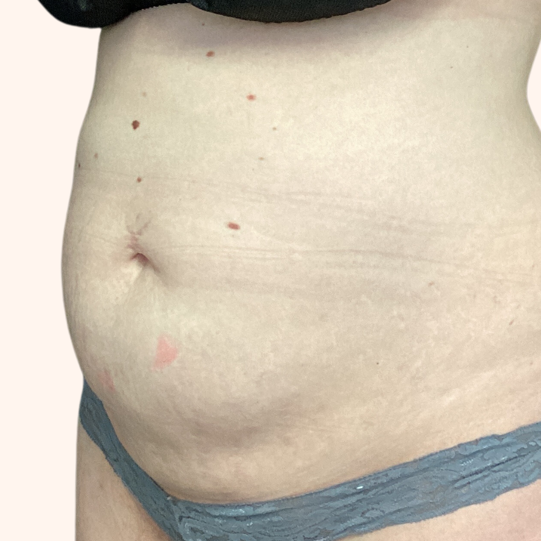 Coolsculpting after