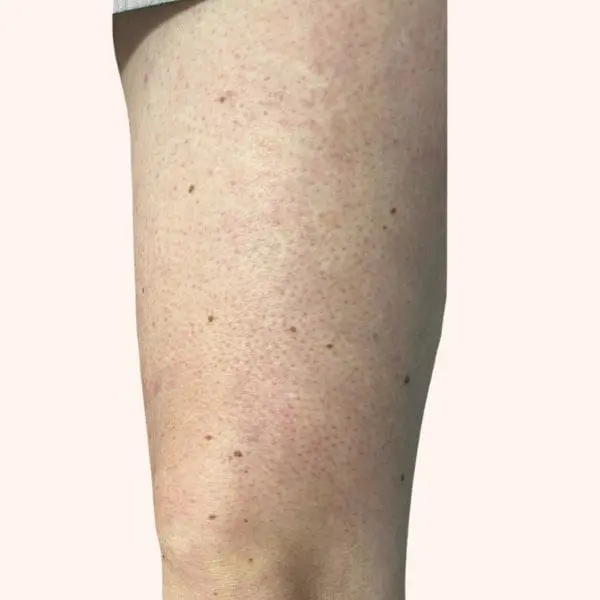 Sclerotherapy after