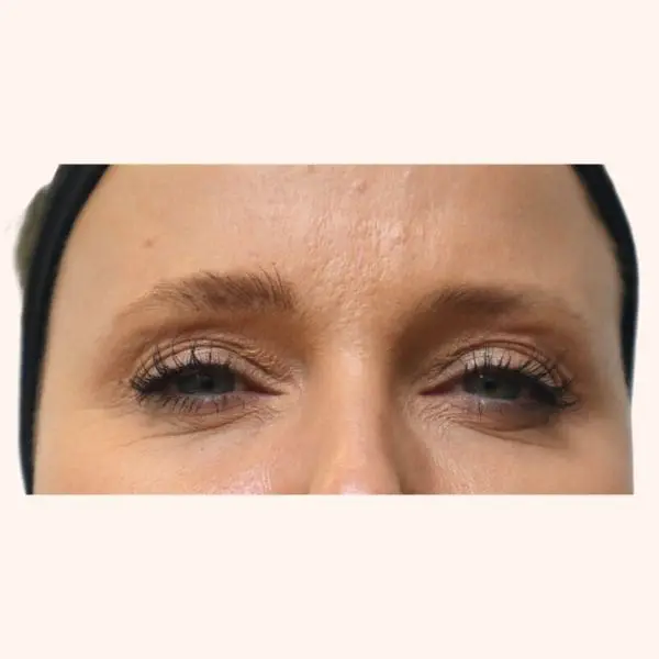 anti wrinkle after