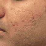 PRP MICRONEEDLING BEFORE