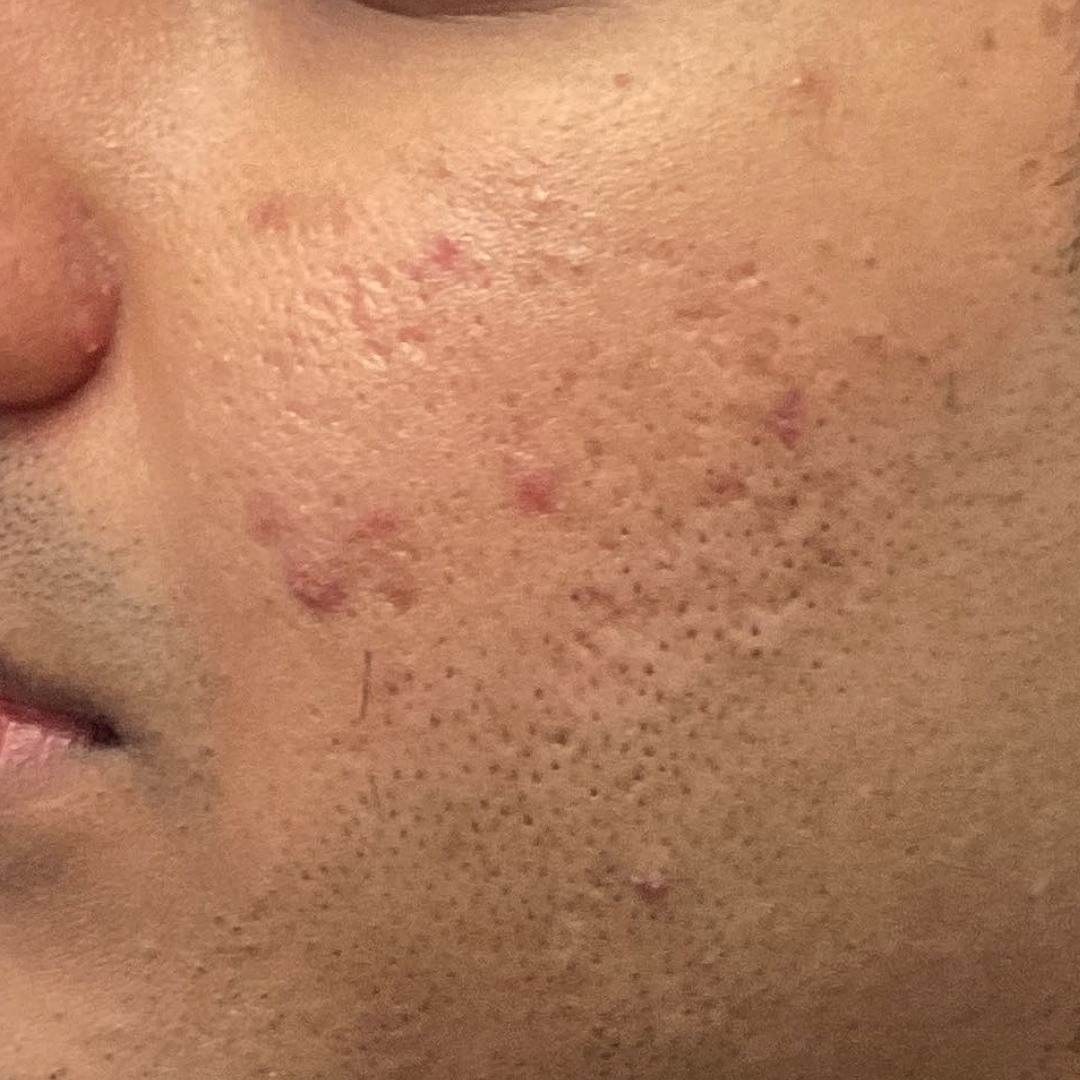 PRP MICRONEEDLING BEFORE