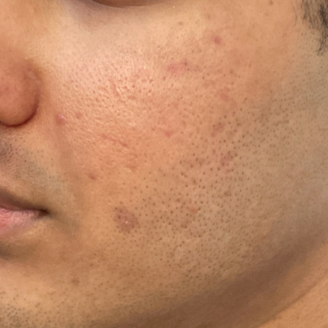 PRP MICRONEEDLING AFTER